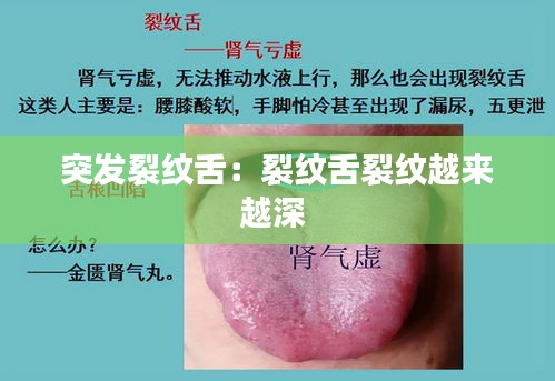 突发裂纹舌：裂纹舌裂纹越来越深 