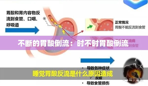 不断的胃酸倒流：时不时胃酸倒流 