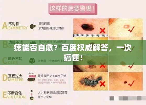 痣能否自愈？百度权威解答，一次搞懂！