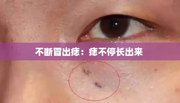 不断冒出痣：痣不停长出来 