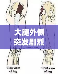 大腿外侧突发剧烈疼痛：大腿外侧突然很疼 