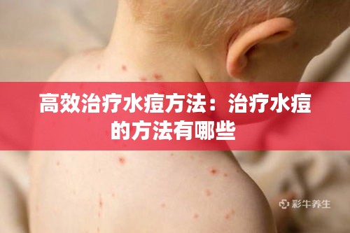 高效治疗水痘方法：治疗水痘的方法有哪些 