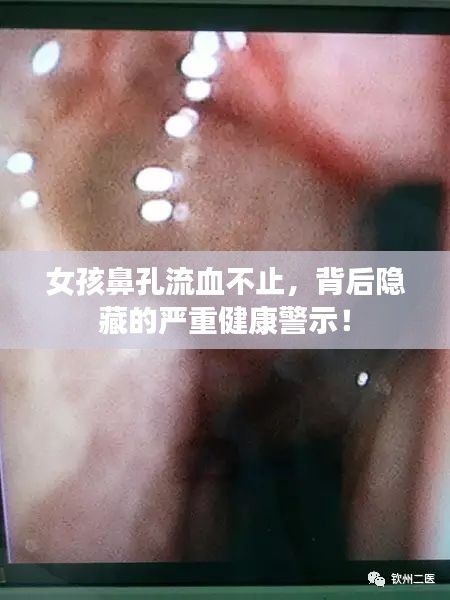 女孩鼻孔流血不止，背后隐藏的严重健康警示！