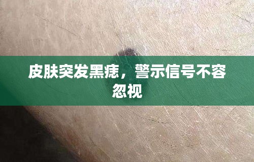 皮肤突发黑痣，警示信号不容忽视